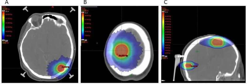 Metastases Archives | Accuray Exchange
